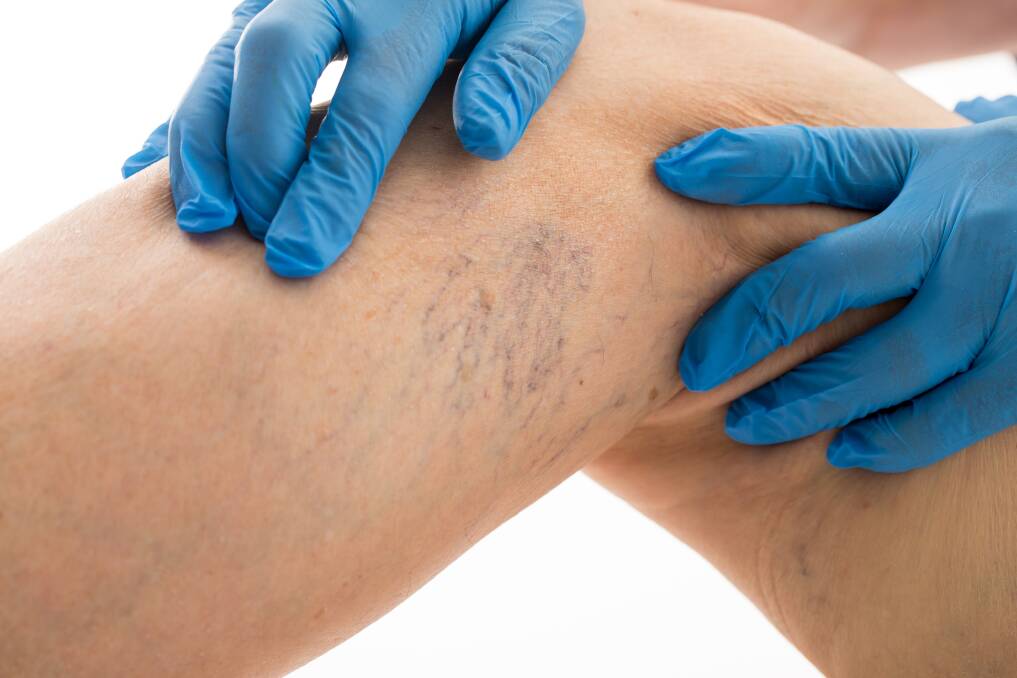 PROFESSIONAL ASSESSMENT Thorough evaluation and detailed discussion of treatment options enables patients at Hunter Vein Clinic to make informed decisions regarding their management.
