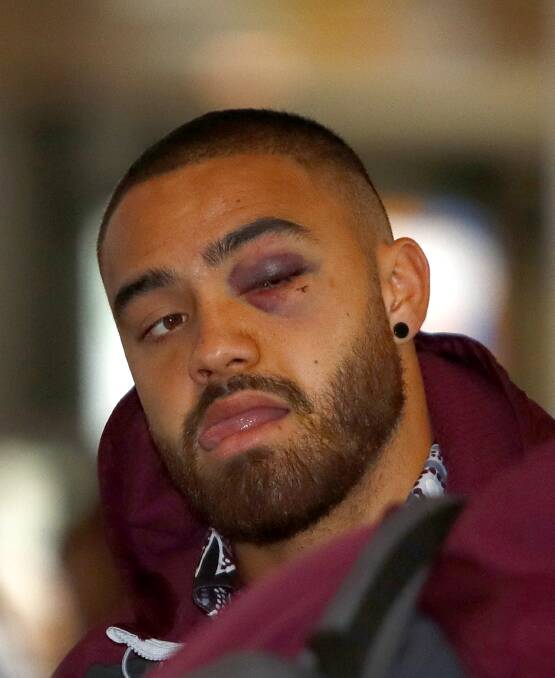 AN EYE FOR AN EYE: Dylan Walker sports a shiner after his disagreement with Melbourne centre Curtis Scott. Picture: AAP
