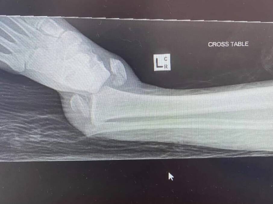 An X-ray of Luke Remington's leg.