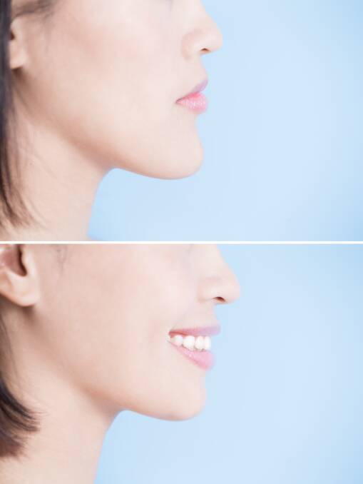 BEFORE AND AFTER: Corrective jaw surgery corrects common conditions such as a protruding lower jaw, where the lower teeth sit in front of the top teeth.