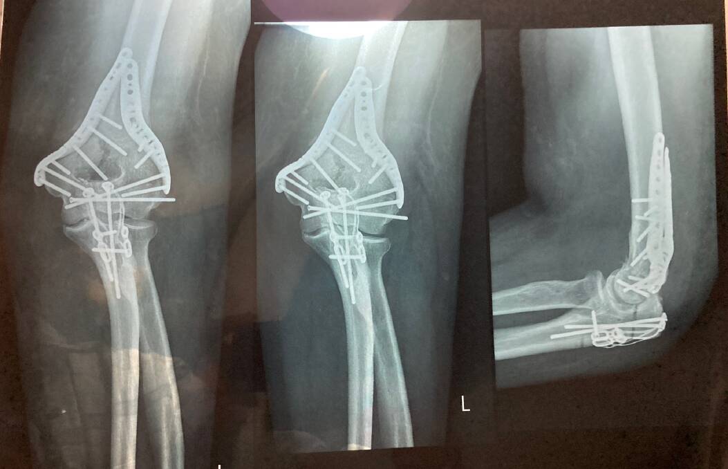 A severe break: An x-ray of Mark Howe's arm after his surgery.