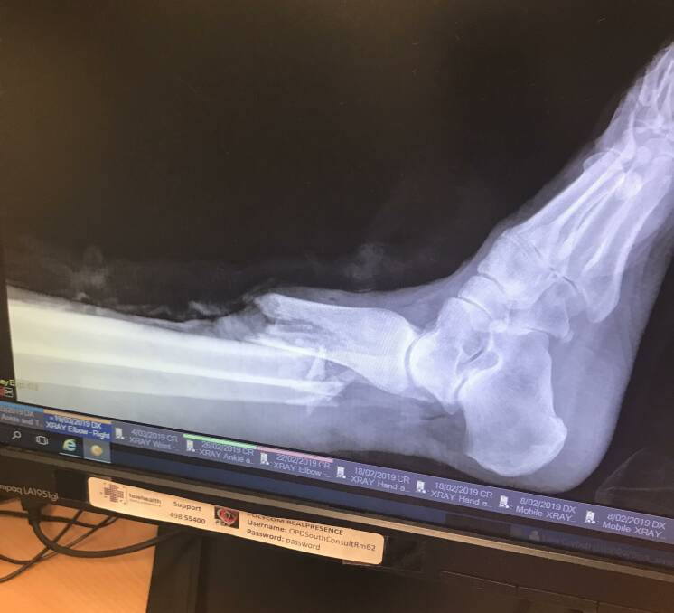 Big break: Elizabeth Stringer's leg was horrifically injured after being crushed by her own sports car.