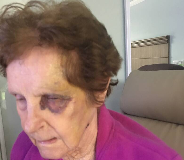 Injuries: Patricia Anson after another unwitnessed fall at an aged care facility.