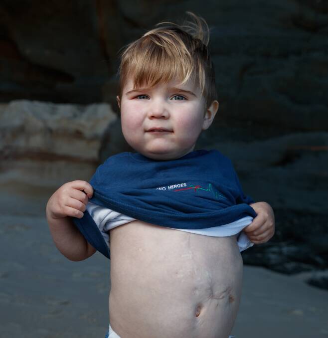 Jack Kenny, 3, shows off his scar after a heart transplant last year. Picture: Max Mason-Hubers