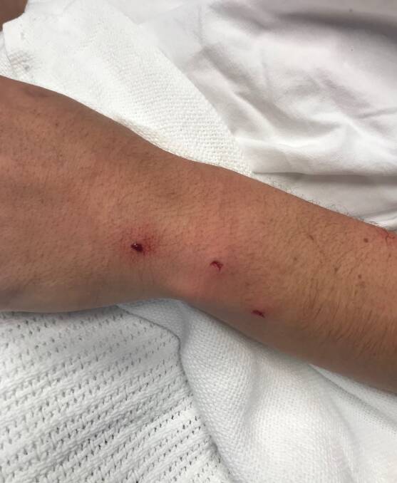 Calling card: The bite mark on Mr Carey's arm. He was treated with antibiotics as a precaution against infection. Picture: Max Mason-Hubers. 