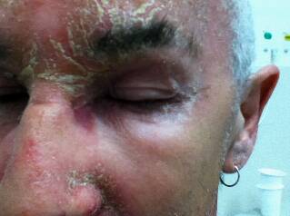 Severe skin reaction after contact with petroleum fumes.