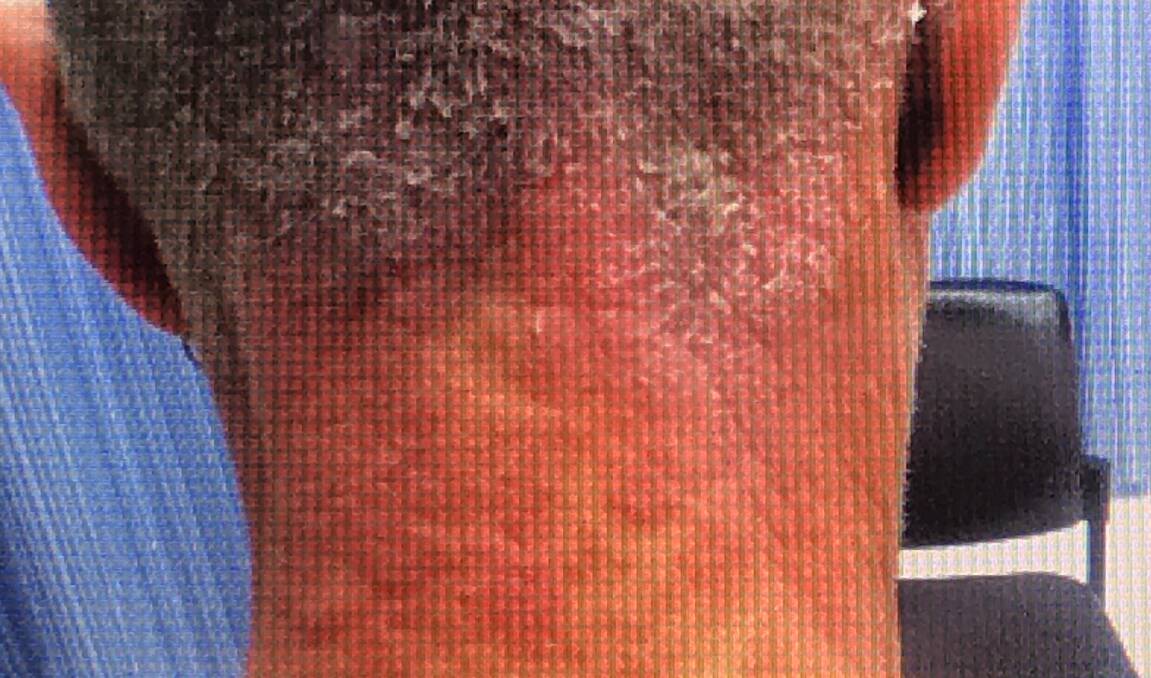 The rash on the back of his neck during another trip to hospital. 