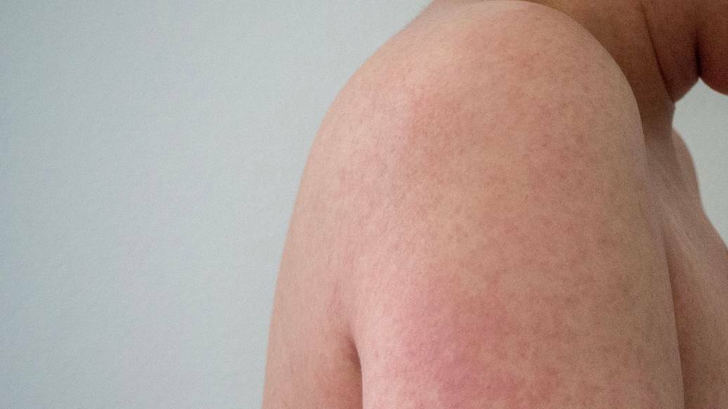 Measles alert: Hunter carrier had been vaccinated, NSW Health confirms