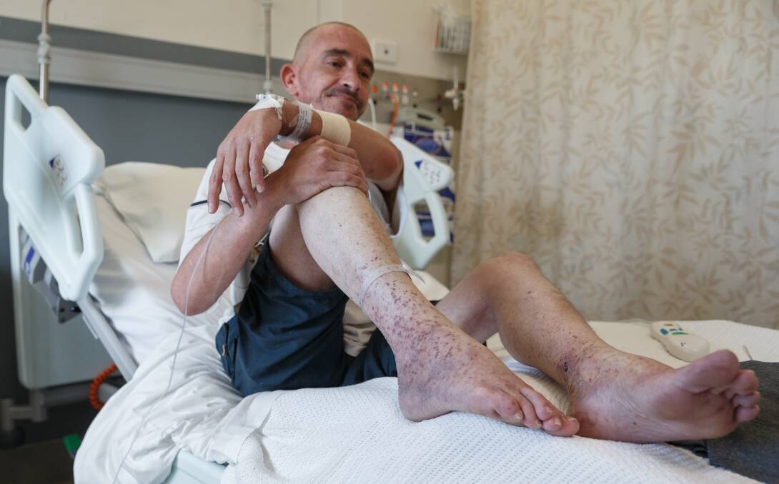 ROUGH RUN: Colin Marlow in hospital on Friday showing the bed bug bites on his legs. Pictures: Max Mason-Hubers