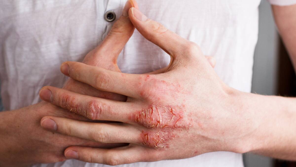 Eczema is a chronic condition so you can't get rid of it permanently, but there are lots of ways to effectively control and avoid it. 