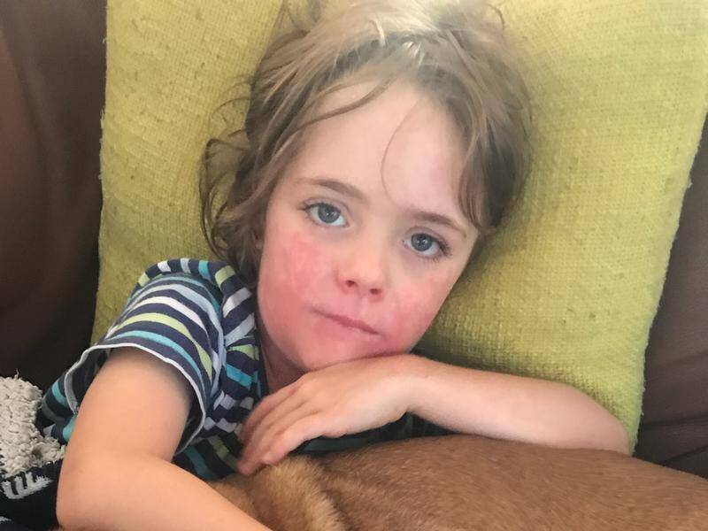 Sydney boy Sonny had an allergic reaction to a well-known sunscreen and his mum wants label changes.