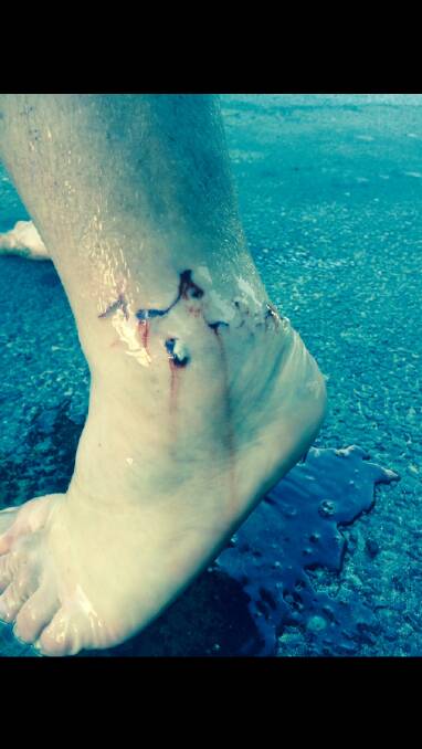 Injuries inflicted by a shark to a man at McKenzies Beach, Malua Bay, on Saturday, April 11. PICTURE: Danny Freeman.