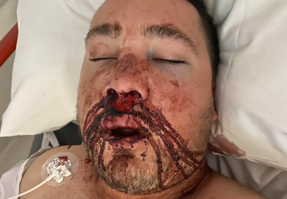 Injured: Michael Fitzsimmons at the Mater Hospital after he was savagely set upon during a night out in Newcastle.