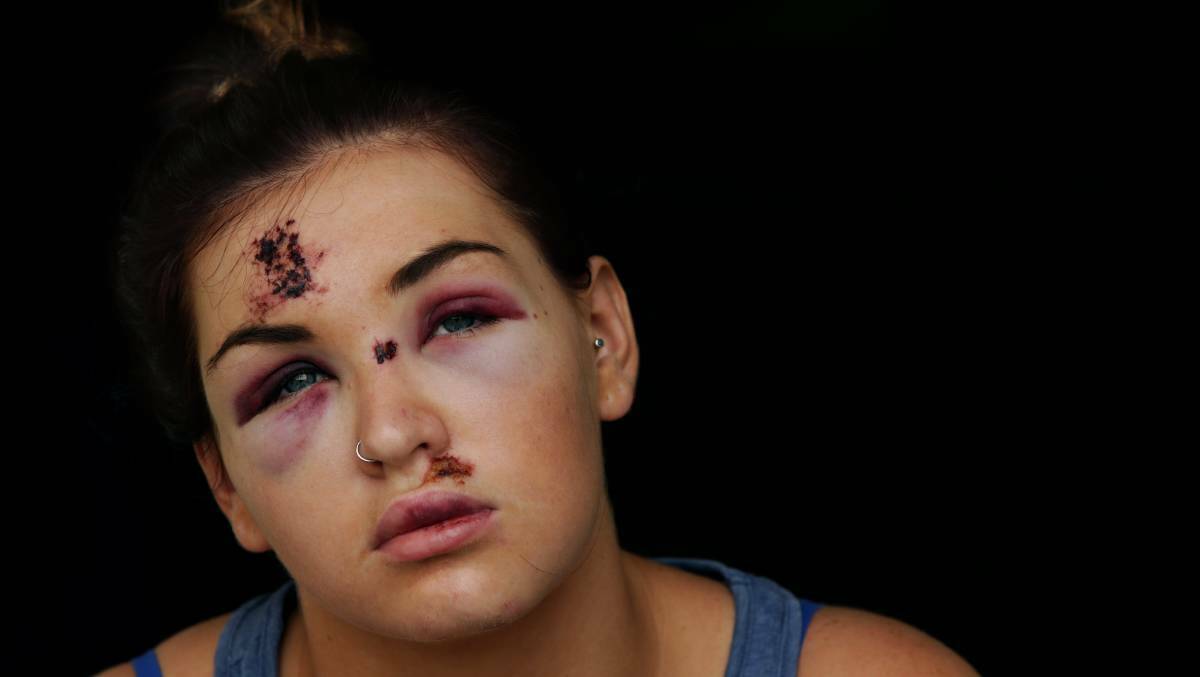 BASHED: Brittany Merrick at home a few days after she was allegedly assaulted by Shaun Rudder on King Street. Picture: Simone De Peak. 