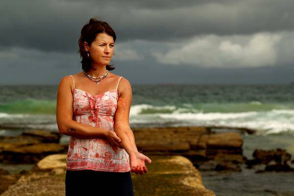 Shark attack victim Lisa Mondy, who has called for the removal of shark nets.