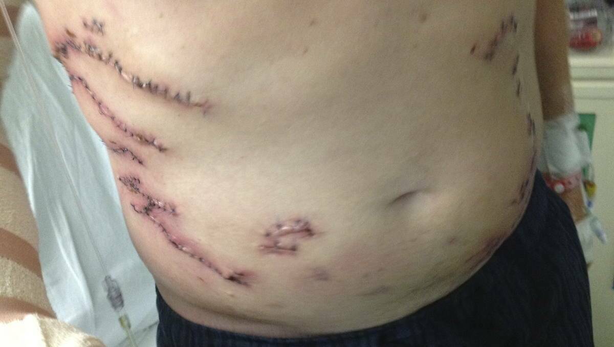 John Hines of Dudley was attacked by a Tiger shark in Western Australia in August. 