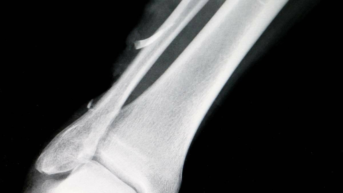 An X-ray showing a piece of the shark's tooth lodged in Allan Saunders' leg.